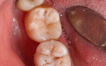 龋齿树脂补牙[治疗后]