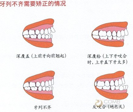 矫正牙列不齐需要注意什么