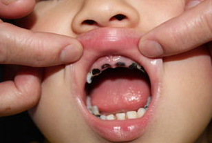 儿童龋齿的预防方法