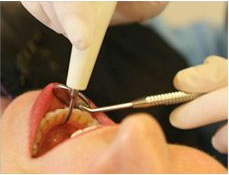 根管治疗后牙齿寿命是多久