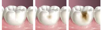 龋齿的产生与哪些因素有关呢