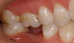 乳牙患上蛀牙都有哪些伤害