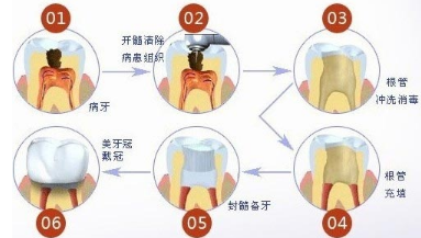 根管治疗的知识