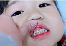 儿童蛀牙该怎么治疗
