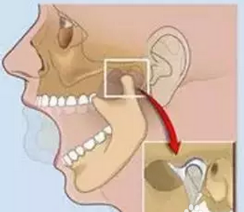双颌前突术后如何正确的护理