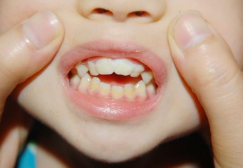 儿童畸形牙齿矫正需要注意的事项