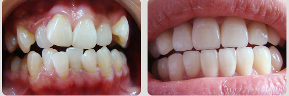畸形牙齿不矫正的危害有哪些