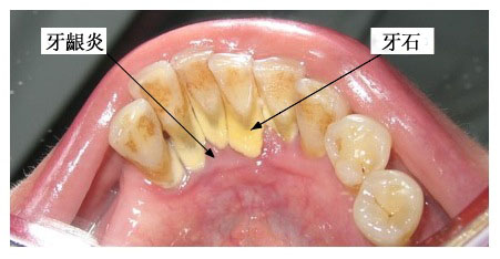 病菌滋生的温床：牙结石
