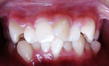 畸形牙齿矫正有后遗症吗？