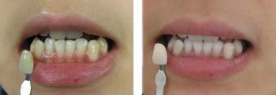 洗牙会有危害方面的影响吗