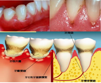 牙龈炎和牙周炎有什么区别吗?
