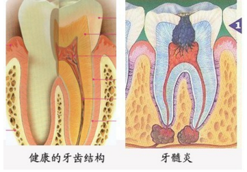 慢性牙髓炎该怎样诊断