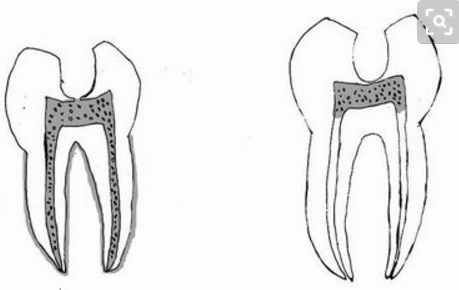 什么是逆行性牙髓炎