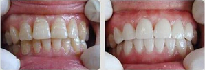 四环素牙能用瓷贴面修复吗