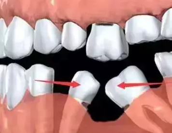医师揭秘个别牙齿缺失不修复的“恶果”