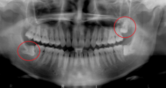 智齿的并发症有哪些