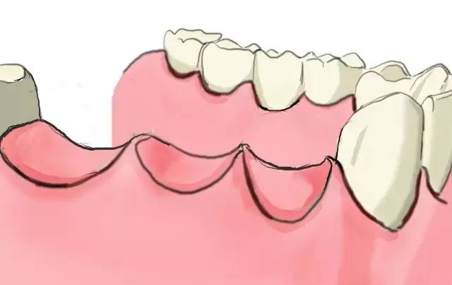 多颗牙缺失令人“未老先衰”怎么办？