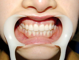 牙齿做隐形矫正有哪些注意事项?