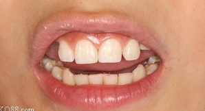 如何预防儿童前牙外伤