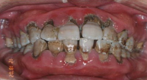 哪些因素会导致慢性牙龈炎呢