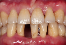 牙齿现象告诉你该怎么护牙