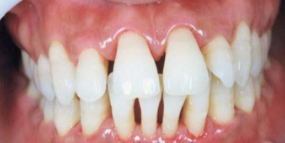 患牙周炎影响矫牙吗