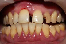 牙周病导致牙齿松动怎么办