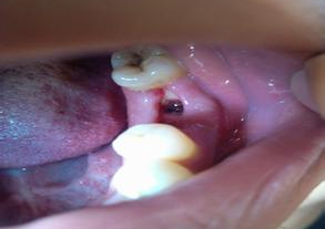 拔牙的后遗症有哪些