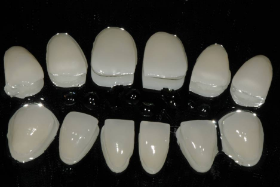 瓷贴面牙齿美白的特点有哪些