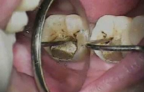 儿童龋齿是由哪些原因导致的
