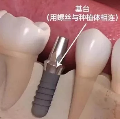 牙能种植吗