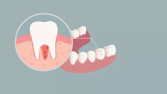 牙周炎怎么治疗