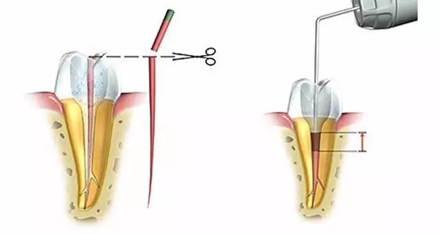 根管治疗