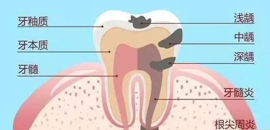 小孩牙齿有个洞怎么办
