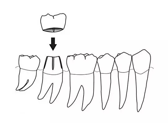 牙冠一般能用多久